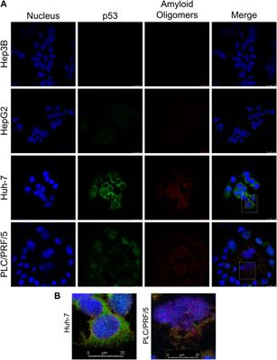 PRIMA-1 inhibits Y220C p53 amyloid aggregation and synergizes with cisplatin in hepatocellular carcinoma